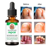 Onychomycosis Repair Bacteriostatic Liquid designed to treat fungal nail infections